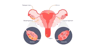 Expert care for fibroids, PCOS, and irregular menstruation