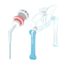 Knee and hip joint replacement surgery using advanced techniques